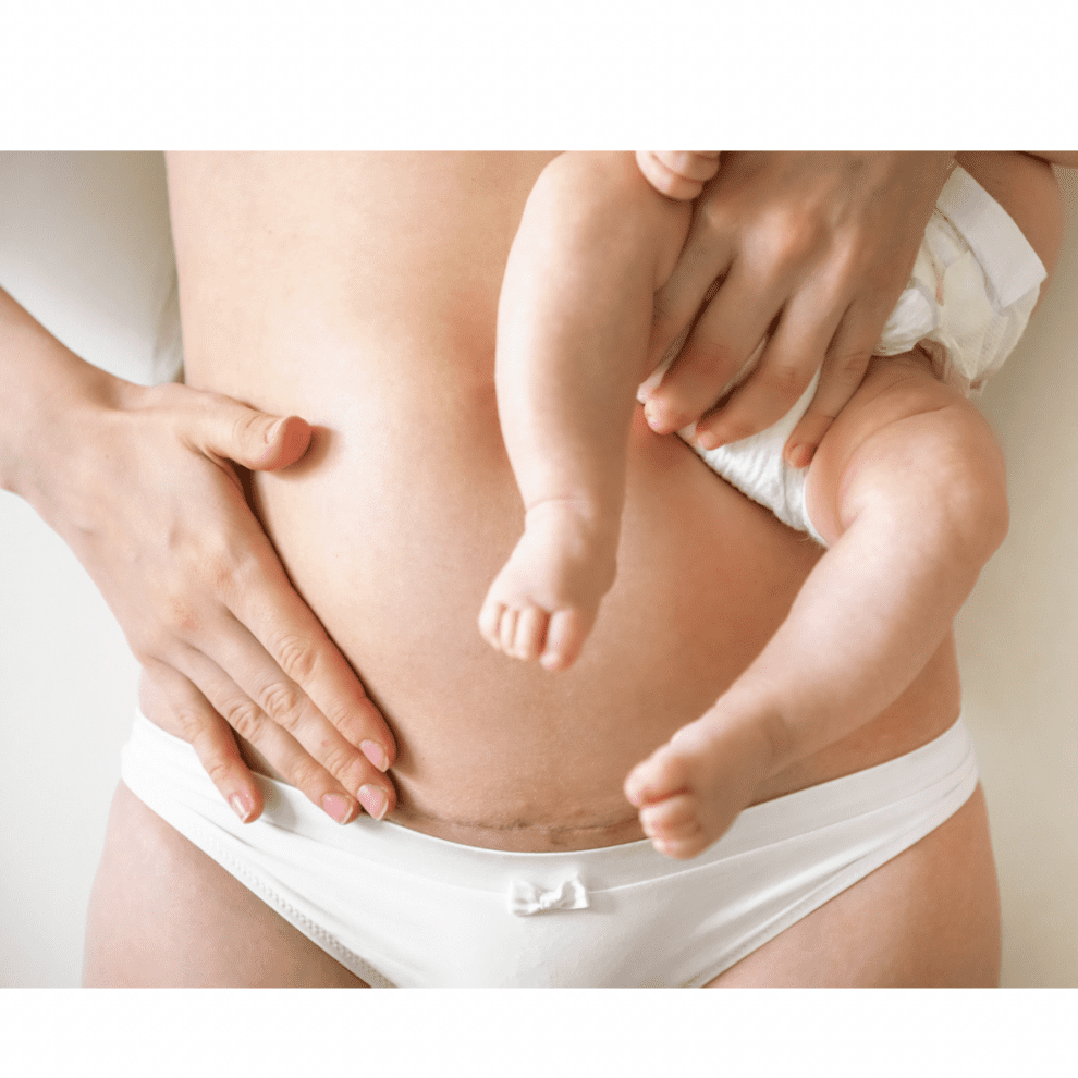 Frau mit Kaiserschnittnarbe hält wenige Monate nach der Geburt ihr Baby im Arm
